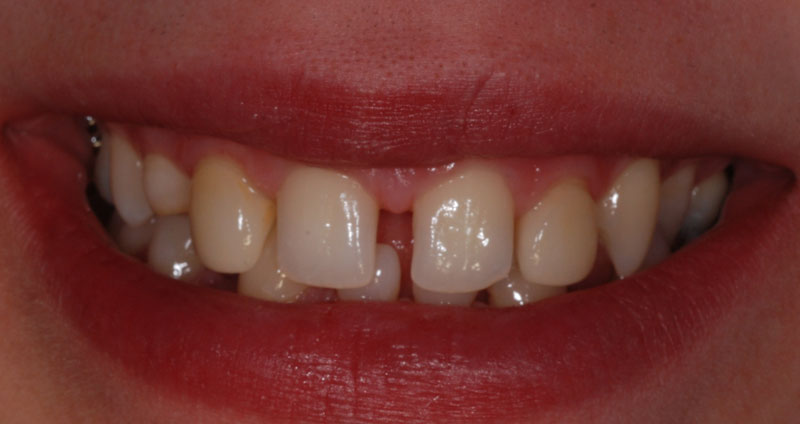 pre ortho treatment