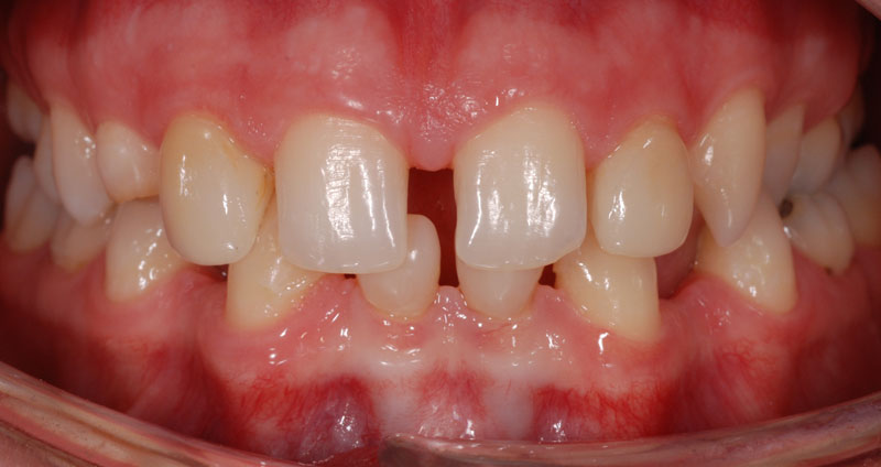 pre ortho treatment