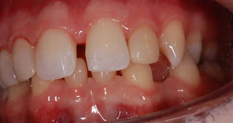 pre ortho treatment
