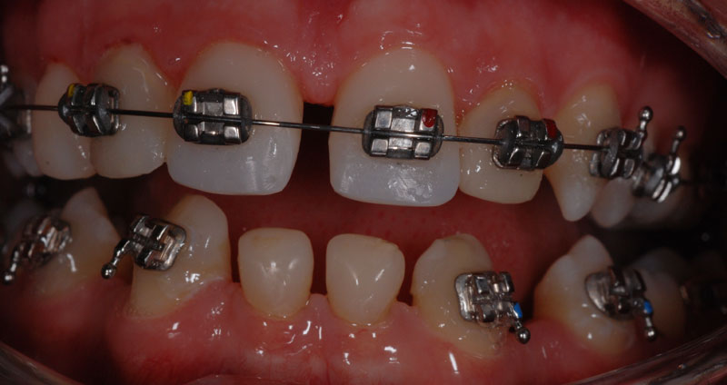 pre ortho treatment