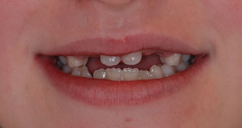 multiple agenesia