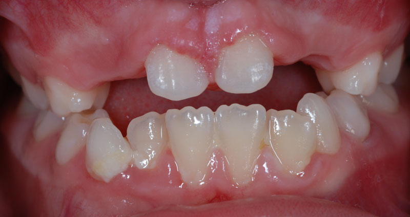 multiple agenesia