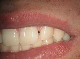 Diastema Closing