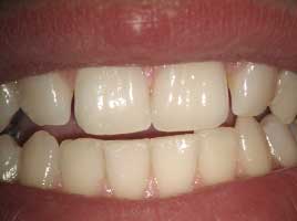 Diastema Closing