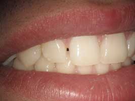 Diastema Closing