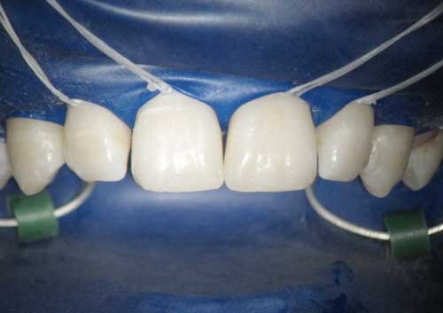 Diastema Closing