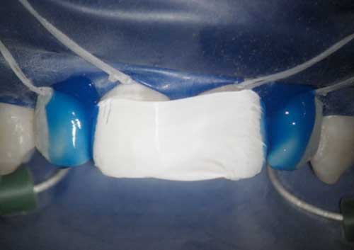 Diastema Closing