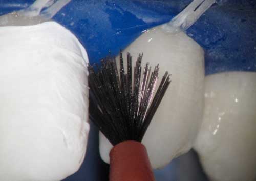 Diastema Closing
