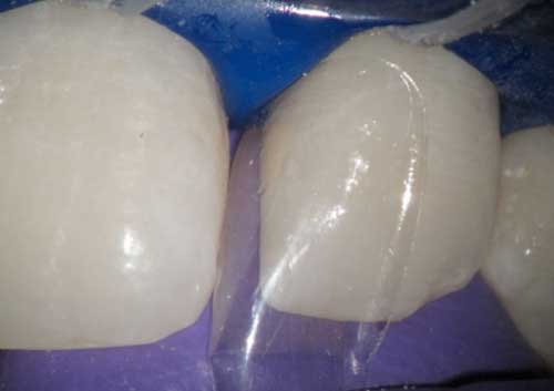 Diastema Closing