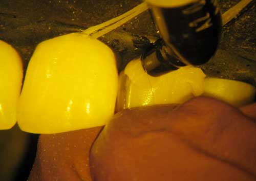 Diastema Closing