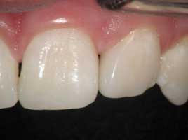 Diastema Closing