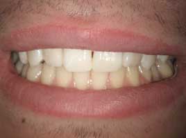 Diastema Closing