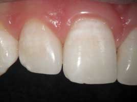 Diastema Closing
