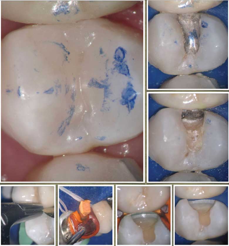 pre ortho treatment
