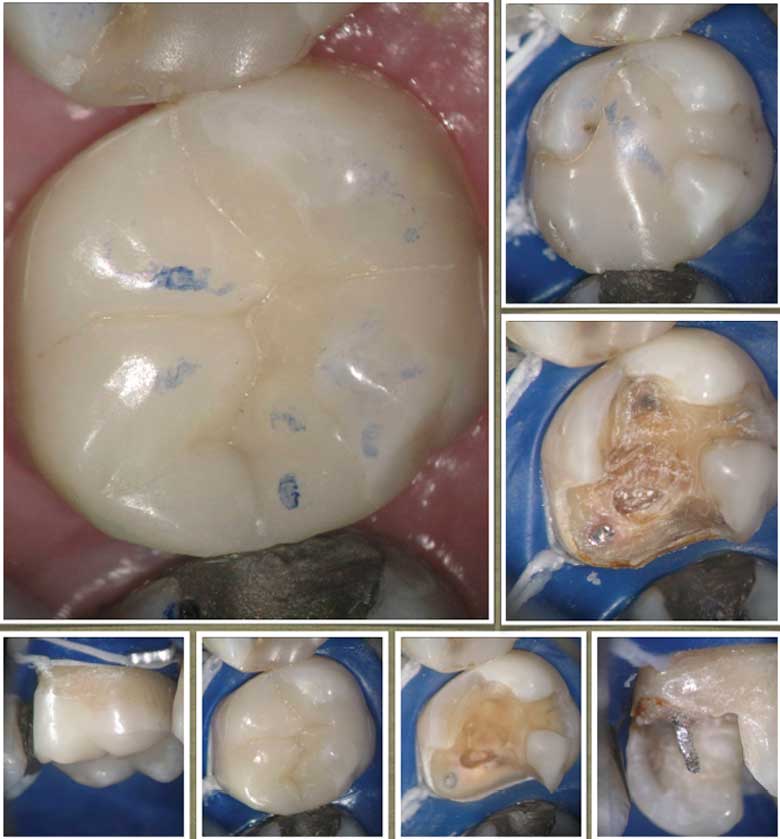 Secundair Caries under Posterior restoration