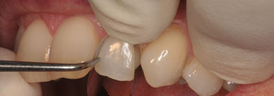 Protocol for veneer restauration