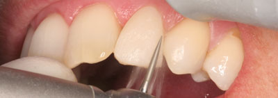Protocol for veneer restauration