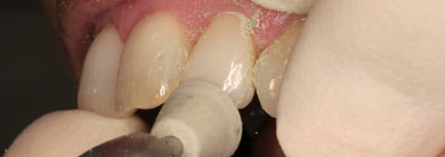 Protocol for veneer restauration