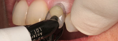 Protocol for veneer restauration
