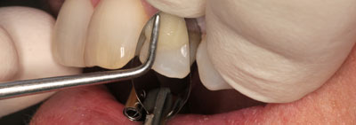 Protocol for veneer restauration