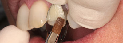 Protocol for veneer restauration