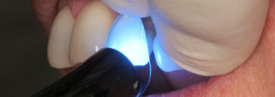 Protocol for veneer restauration