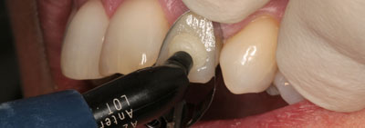 Protocol for veneer restauration