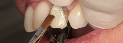 Protocol for veneer restauration