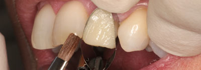 Protocol for veneer restauration