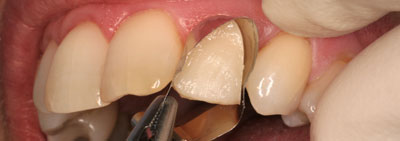 Protocol for veneer restauration